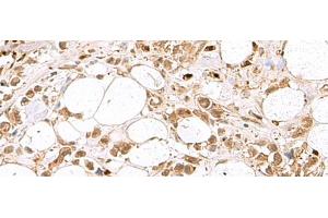 Immunohistochemistry of paraffin-embedded Human breast cancer tissue using RBFOX2 Polyclonal Antibody at dilution of 1:80(x200) (RBM9 antibody)