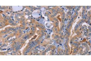 Immunohistochemistry of paraffin-embedded Human thyroid cancer using CD327 Polyclonal Antibody at dilution of 1:70 (SIGLEC6 antibody)