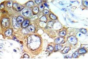 Immunohistochemistry (IHC) analyzes of c-RAF antibody in paraffin-embedded human breast carcinoma tissue. (RAF1 antibody)