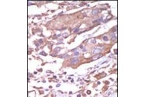 Formalin-fixed and paraffin-embedded human cancer tissue reacted with the primary antibody, which was peroxidase-conjugated to the secondary antibody, followed by AEC staining. (CAMK2A antibody  (C-Term))