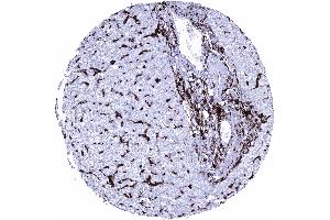 Liver Intense HLA DRB1 staining of inflammatory cells and of Kupffer cells HLA DRB1 immunohistochemistry (Recombinant HLA-DRB1 antibody)