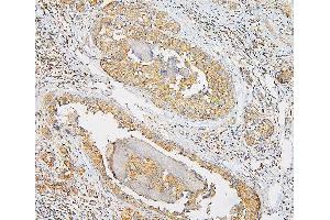 IHC analysis of IQGAP1 using anti-IQGAP1 antibody (ABIN6719262). (IQGAP1 antibody)