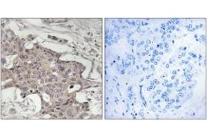Immunohistochemistry analysis of paraffin-embedded human breast carcinoma tissue, using HIBADH Antibody.