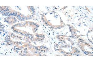 Immunohistochemistry of paraffin-embedded Human colon cancer using ALDH1A2 Polyclonal Antibody at dilution of 1:60 (ALDH1A2 antibody)