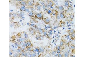 Immunohistochemistry of paraffin-embedded Human breast cancer using PSMD10 Polyclonal Antibody at dilution of 1:100 (40x lens). (PSMD10 antibody)