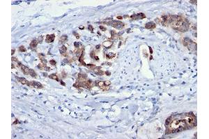Formalin-fixed, paraffin-embedded human Gastric Carcinoma stained with CDC20 Mouse Monoclonal Antibody (AR12). (CDC20 antibody)