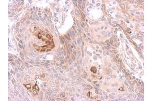 IHC-P Image Immunohistochemical analysis of paraffin-embedded cal27 xenograft, using MST4 antibody, antibody at 1:500 dilution. (STK26/MST4 antibody  (Center))