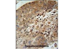 ACD10 Antibody (Center) (ABIN654760 and ABIN2844444) immunohistochemistry analysis in formalin fixed and paraffin embedded human hepatocarcinoma followed by peroxidase conjugation of the secondary antibody and DAB staining. (ACAD10 antibody  (AA 393-421))