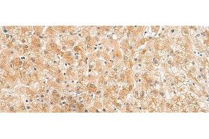 Immunohistochemistry of paraffin-embedded Human liver cancer tissue using ZNF185 Polyclonal Antibody at dilution of 1:25(x200) (Zinc Finger Protein 185 antibody)
