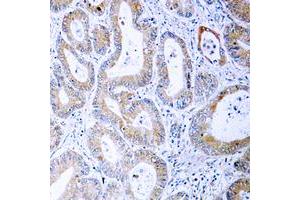 Immunohistochemical analysis of MKK1/2 (pS222/226) staining in human colon cancer formalin fixed paraffin embedded tissue section. (MEK1 antibody  (pSer222, pSer226))