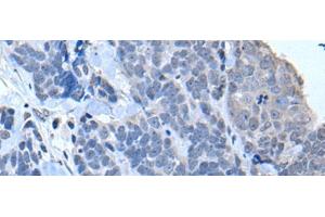 Immunohistochemistry of paraffin-embedded Human thyroid cancer tissue using TIA1 Polyclonal Antibody at dilution of 1:30(x200) (TIA1 antibody)