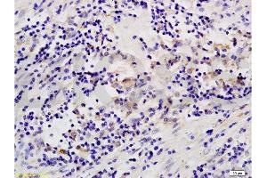 Formalin-fixed and paraffin embedded human colon carcinoma labeled with Anti-MAP3K8/TPL2 Polyclonal Antibody, Unconjugated  at 1:200 followed by conjugation to the secondary antibody and DAB staining. (MAP3K8 antibody  (AA 121-220))