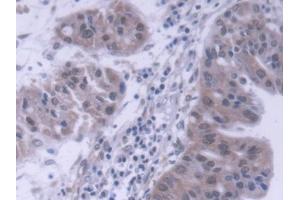 DAB staining on IHC-P; Samples: Human Liver cancer Tissue (DP1 antibody  (AA 6-410))