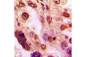 Immunohistochemical analysis of ZFP36L2 staining in human lung cancer formalin fixed paraffin embedded tissue section.