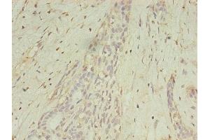 Immunohistochemistry of paraffin-embedded human breast cancer using ABIN7159252 at dilution of 1:100 (MAGEA1 antibody  (AA 2-225))