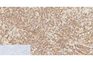 Immunohistochemistry of paraffin-embedded Human breast cancer tissue using Phospho-Catenin beta (Ser37) Polyclonal Antibody at dilution of 1:200 (beta Catenin antibody  (pSer37))