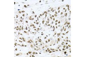 Immunohistochemistry of paraffin-embedded human lung cancer using BCCIP antibody (ABIN5995871) at dilution of 1/100 (40x lens). (BCCIP antibody)