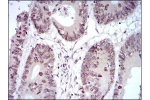 Immunohistochemical analysis of paraffin-embedded colon cancer tissues using HOXB4 mouse mAb with DAB staining.