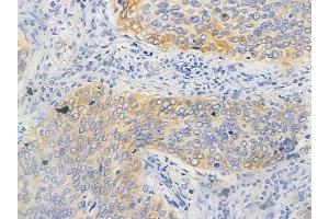 ABIN6263203 and ABIN6266781 at 1/100 staining human pancreatic carcinoma by IHC-P.