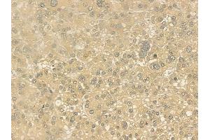 ABIN6262303 and ABIN6276781 at 1/100 staining human hepatocellular carcinoma by IHC-P.