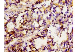 Immunohistochemistry of paraffin-embedded human gastric cancer using ABIN7170131 at dilution of 1:100 (SLC22A1 antibody  (AA 43-149))