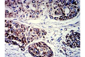 Immunohistochemical analysis of paraffin-embedded ovarian cancer tissues using PIGR mouse mAb with DAB staining. (PIGR antibody  (AA 19-170))