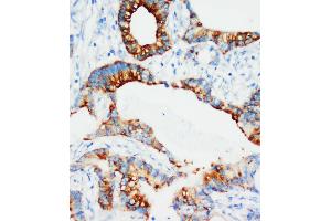Anti-IGFBP3 antibody, IHC(P) IHC(P): Human Mammary Cancer Tissue (IGFBP3 antibody  (Middle Region))