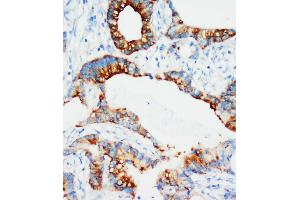 Anti-IGFBP3 antibody, IHC(P) IHC(P): Human Mammary Cancer Tissue