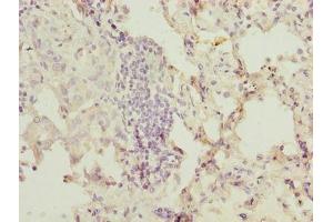 Immunohistochemistry of paraffin-embedded human lung cancer using ABIN7174654 at dilution of 1:100 (OGT antibody  (AA 606-1022))