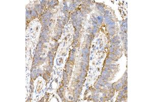 Immunohistochemistry of paraffin-embedded human colon carcinoma using MK4 Rabbit mAb (ABIN7268653) at dilution of 1:50 (40x lens). (MAP3K4 antibody)