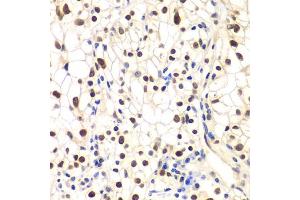 Immunohistochemistry of paraffin-embedded human kidney cancer using NFKBIB antibody (ABIN6130475, ABIN6144584, ABIN6144585 and ABIN6221459) at dilution of 1:200 (40x lens).