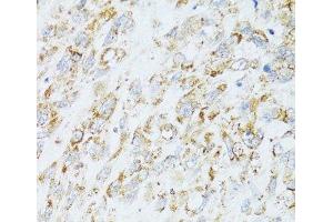 Immunohistochemistry of paraffin-embedded Human lung cancer using EGFR Polyclonal Antibody at dilution of 1:100 (40x lens). (EGFR antibody)