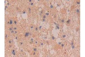 Detection of DDAH2 in Human Glioma Tissue using Polyclonal Antibody to Dimethylarginine Dimethylaminohydrolase 2 (DDAH2)