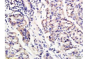 Formalin-fixed and paraffin embedded human gastritis labeled with Rabbit Anti TREM2 Polyclonal Antibody, Unconjugated (ABIN749678) at 1:200 followed by conjugation to the secondary antibody and DAB staining (TREM2 antibody  (AA 1-100))