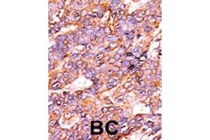 Immunohistochemistry (Formalin/PFA-fixed paraffin-embedded sections) of human breast carcinoma with Histone H3 (phospho S10) polyclonal antibody , followed by peroxidase-conjugated secondary antibody and AEC staining. (Histone H3.3 antibody  (pSer10))