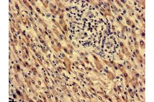 Immunohistochemistry analysis of human liver cancer using ABIN7172382 at dilution of 1:100 (MECR antibody  (AA 211-373))