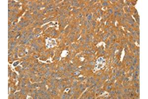The image on the left is immunohistochemistry of paraffin-embedded Human ovarian cancer tissue using ABIN7131067(SIRT4 Antibody) at dilution 1/25. (SIRT4 antibody)