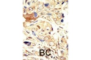 Formalin-fixed and paraffin-embedded human cancer tissue reacted with the primary antibody, which was peroxidase-conjugated to the secondary antibody, followed by AEC staining.