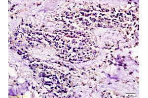 Formalin-fixed and paraffin embedded human colon carcinoma labeled with Anti CCR7/CD197 Polyclonal Antibody, Unconjugated (ABIN674724) at 1:200 followed by conjugation to the secondary antibody and DAB staining