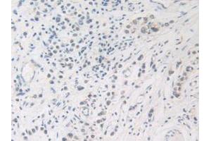 IHC-P analysis of Human Stomach Cancer Tissue, with DAB staining. (FDFT1 antibody  (AA 269-417))