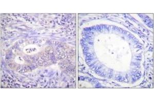 Immunohistochemistry analysis of paraffin-embedded human colon carcinoma, using PFKFB2 (Phospho-Ser483) Antibody. (PFKFB2 antibody  (pSer483))