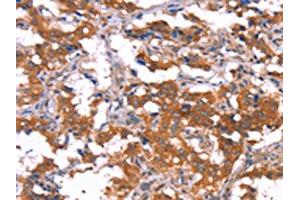 The image on the left is immunohistochemistry of paraffin-embedded Human thyroid cancer tissue using ABIN7190910(HCAR2 Antibody) at dilution 1/40, on the right is treated with synthetic peptide.
