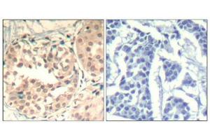 Immunohistochemical analysis of paraffin-embedded human breast carcinoma tissue using CDK6(Phospho-Tyr13) Antibody(left) or the same antibody preincubated with blocking peptide(right). (CDK6 antibody  (pTyr13))
