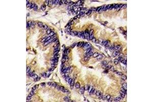IHC analysis of FFPE human lung carcinoma tissue stained with VEGFB antibody (VEGFB (VEGF2) (AA 110-139) antibody)