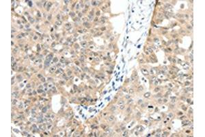The image on the left is immunohistochemistry of paraffin-embedded Human ovarian cancer tissue using ABIN7130157(MAP3K14 Antibody) at dilution 1/30, on the right is treated with fusion protein. (MAP3K14 antibody)