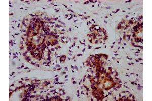 IHC image of ABIN7127690 diluted at 1:100 and staining in paraffin-embedded human breast cancer performed on a Leica BondTM system. (Recombinant EIF2S1 antibody  (pSer51))