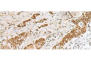 Immunohistochemistry of paraffin-embedded Human esophagus cancer tissue using PNRC2 Polyclonal Antibody at dilution of 1:30(x200) (PNRC2 antibody)