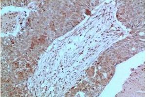 Immunohistochemistry of paraffin-embedded Human breast carcinoma tissue using JAK2 Monoclonal Antibody at dilution of 1:200. (JAK2 antibody)
