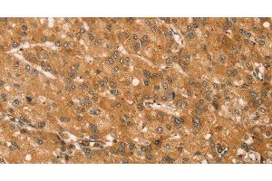 Immunohistochemistry of paraffin-embedded Human liver cancer tissue using SNAP29 Polyclonal Antibody at dilution 1:45 (SNAP29 antibody)