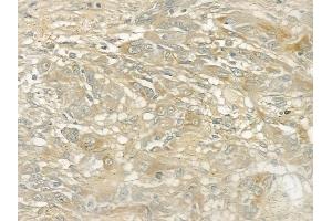ABIN6260440 and ABIN6272875 at 1/100 staining human tongue carcinoma by IHC-P. (CAMSAP2 antibody  (C-Term))